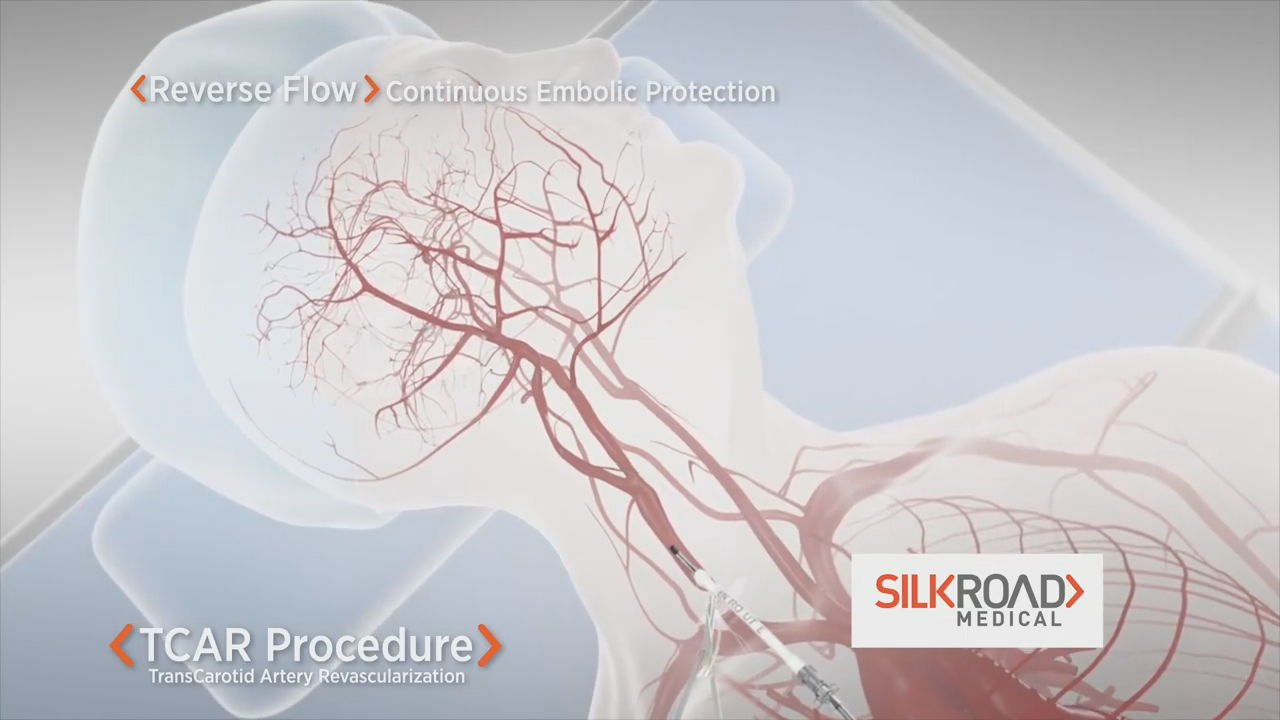 TCAR procedure